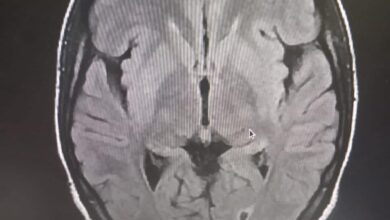 صورة لأول مرة بموريتانيا.. فريق طبي يتمكن من تفتيت جلطة دماغية