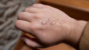 صورة المغرب: تسجيل أول إصابة بجدري القردة