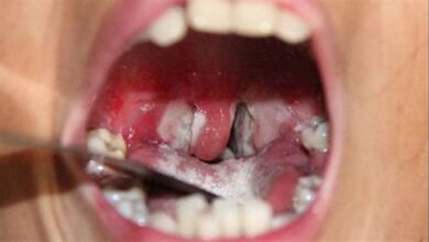 صورة وفاة 7 أشخاص ببلدية تناها وإغلاق الأسواق الأسبوعية بسبب “الدفتيريا”